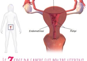 Le 7 cose da sapere sui polipi uterini?
