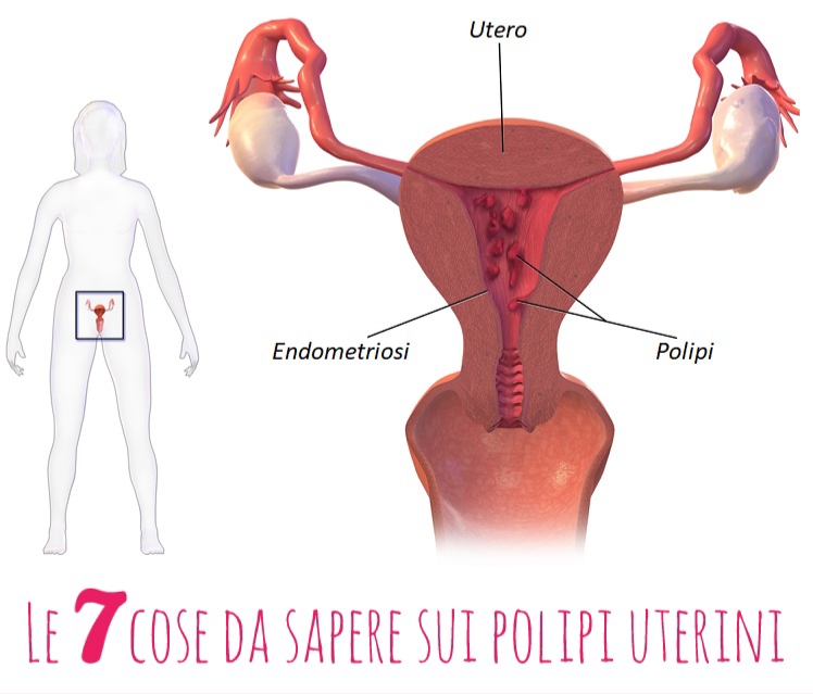 Le 7 cose da sapere sui polipi uterini?