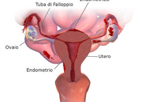 Sintomi dell’Endometriosi