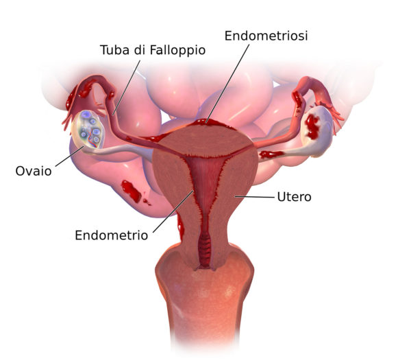 Sintomi dell’Endometriosi