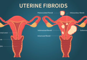 Fibromi Uterini, i principali Sintomi