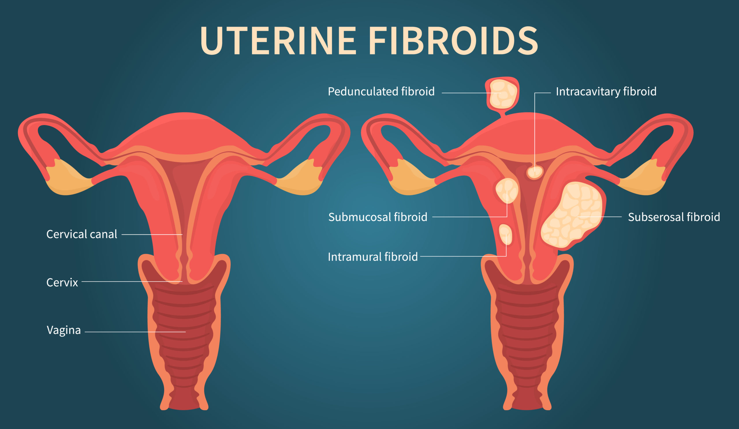 Fibromi Uterini, i principali Sintomi